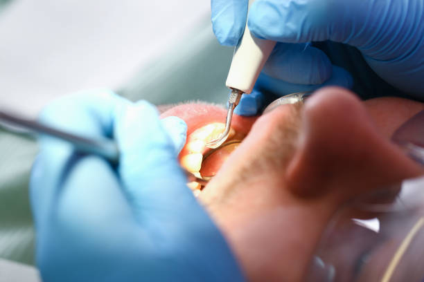 Teeth Whitening in OR