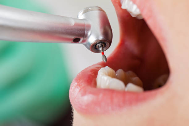 Best Root Canal Emergency Dentist  in Millersburg, OR
